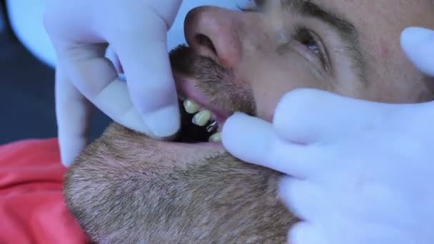 Diş hekimi ayarı metal implant — Stok video