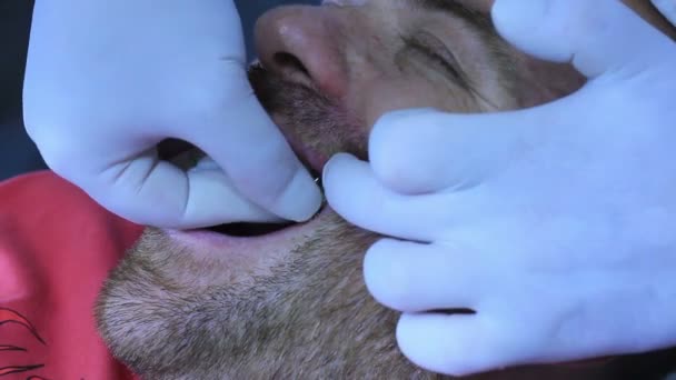Dentiste pose d'implant métallique — Video