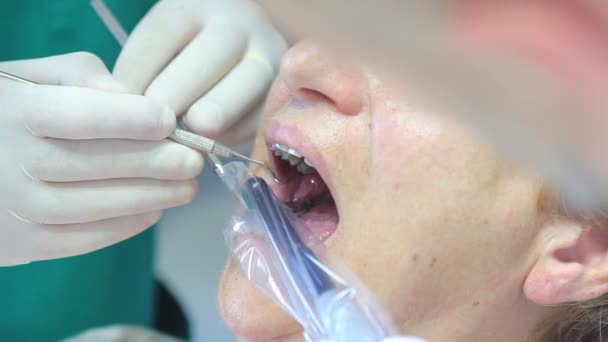 De tandarts met behulp van Uv ultraviolet lamp — Stockvideo