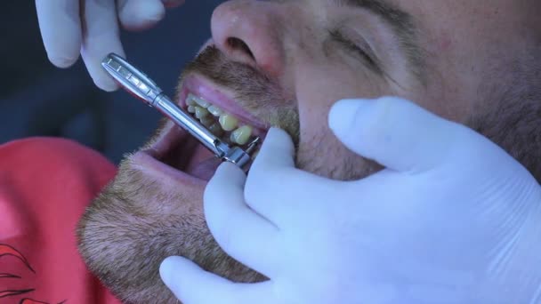 Стоматолог встановлює металевий імплантат — стокове відео