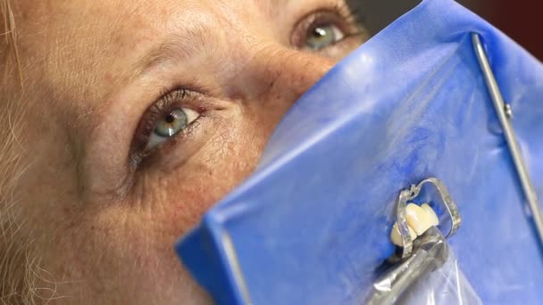 Tandarts apparatuur - vrouwelijke tanden wordt gecontroleerd door arts — Stockvideo