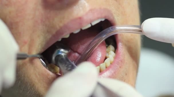 Tandarts - Close-up van patiënt mond open tijdens de mondelinge checkup — Stockvideo
