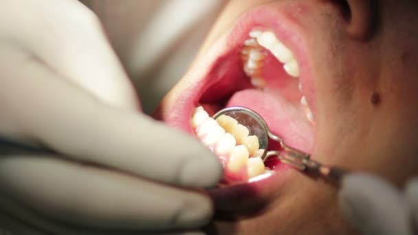 Dentista - Close-up da boca aberta do doente durante o check-up oral — Vídeo de Stock