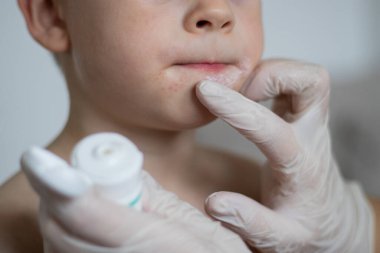 Elleri eldiven ile kapayın, çocukların yüzüne krem sürün, ağzında kızarıklık, arka planda bulanıklık var.