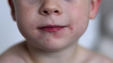 Yüzünde kızarıklık, ağzında kızarıklık ve bulanıklık var. Yüksek kaliteli FullHD görüntüler