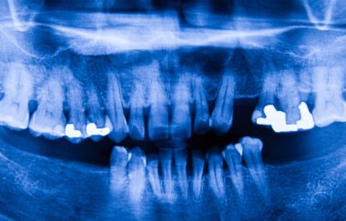 Hastanede insan röntgen filmi