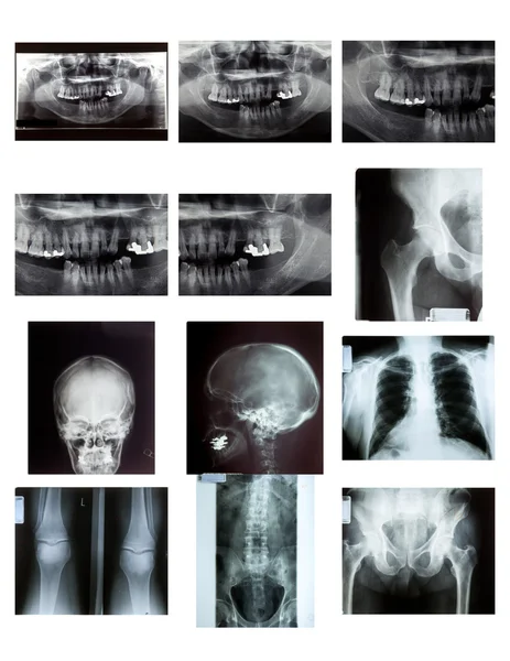 Рентгеновская фотопленка лодыжек и коленного сустава — стоковое фото