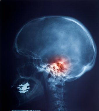 X ışını MRI - görüntü omurga boyun ağrısı ve kafatası kafa Viyadükler