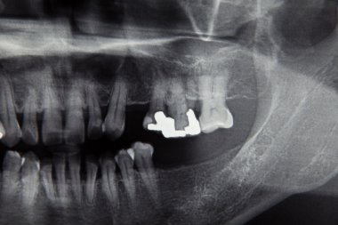 Diş hekimi için panoramik diş röntgen film