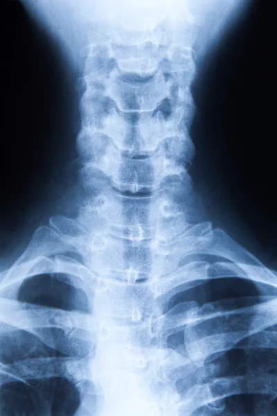 X ray MRI - Image of Spinal Column Neck pain and Skull Head Stre — Stock Photo, Image