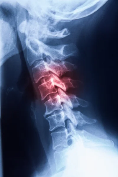 Resonancia magnética de rayos X: imagen del dolor en el cuello de la columna vertebral y la cuerda de la cabeza del cráneo —  Fotos de Stock