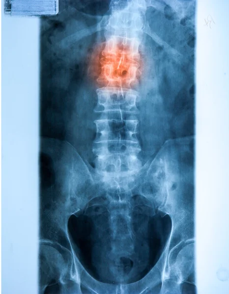 Raio-X MRI - Imagem da coluna vertebral Dor no pescoço — Fotografia de Stock