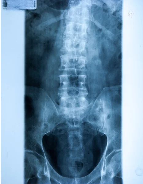 X 레이 Mri-이미지의 척추 목 통증 — 스톡 사진