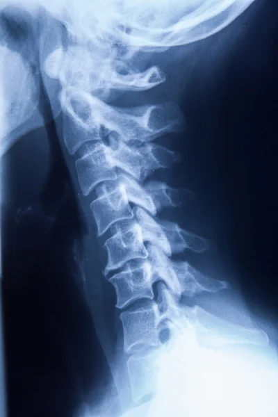 Raio-X MRI - Imagem da coluna vertebral Dor no pescoço e cabeça do crânio Stre — Fotografia de Stock