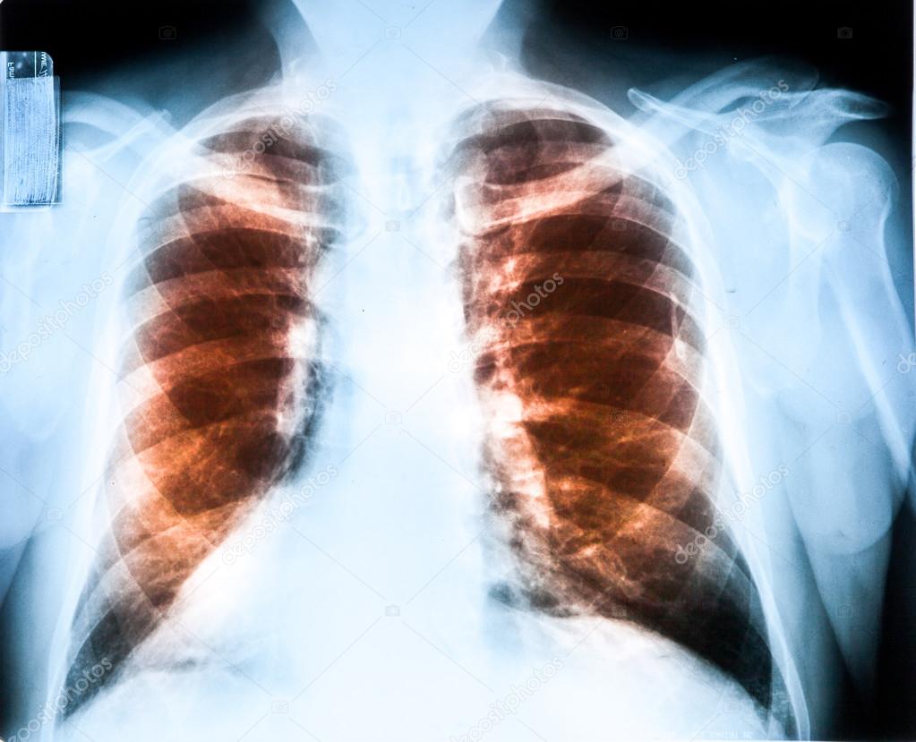 X-Ray MRI Image Of Human Chest