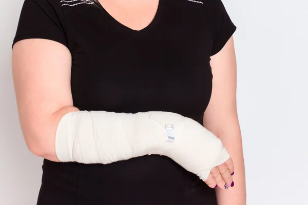 Jovem fêmea com a mão quebrada no elenco — Fotografia de Stock