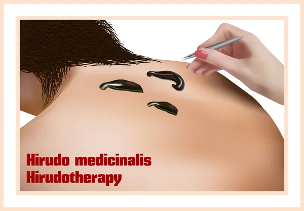 Hirudoterapia. Tratamiento con sanguijuelas . — Vector de stock