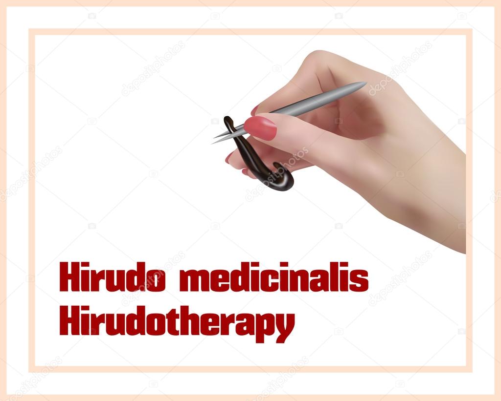 Hirudotherapy. Treatment with leeches.