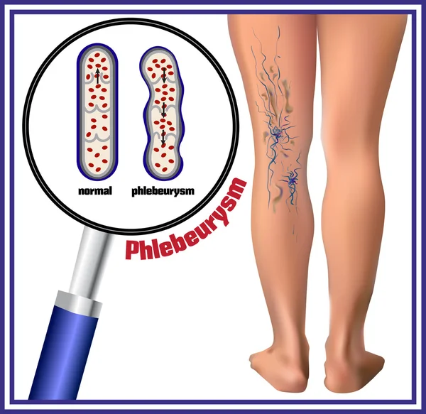 Phlebeurysm. Spataderen. — Stockvector