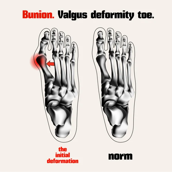 Liktorn. Valgus-deformitet tå. — Stock vektor