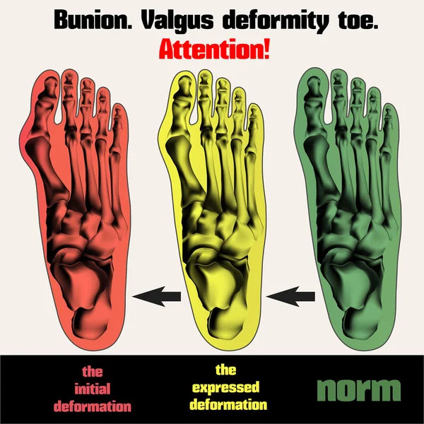 Bunion. Valgus difformité orteil . — Image vectorielle