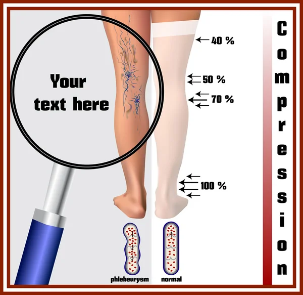 Phlebeurysm. Spataderen. — Stockvector