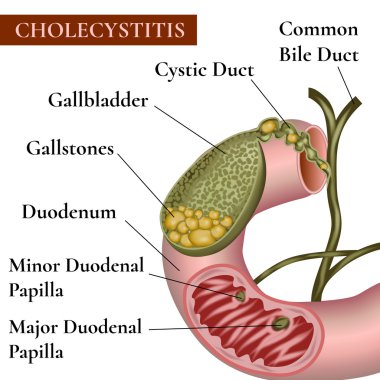 Inflammation of the gallbladder and bile ducts. Gallstones. Calculous cholecystitis. clipart