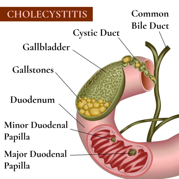 Inflammation of the gallbladder and bile ducts. Gallstones. Calculous cholecystitis. — Stock Vector