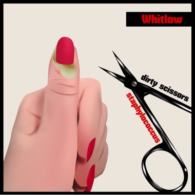 Whitlow. Abse yakınındaki bir tırnak yumuşak doku.