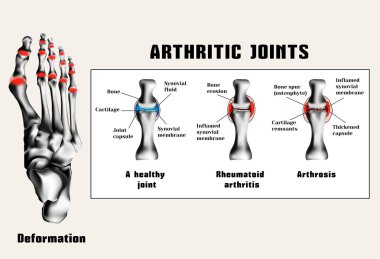 Artritik birleşimler (romatoid artrit, artroz (osteoartrit)). Eklem hastalığı.