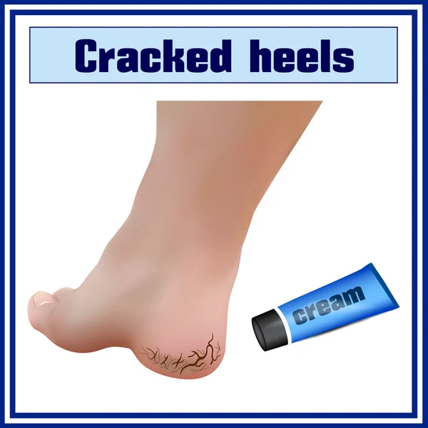 Cracked heels. Foot diseases. — Stock Illustration Cracked heels. Foot diseases. Vector Graphics