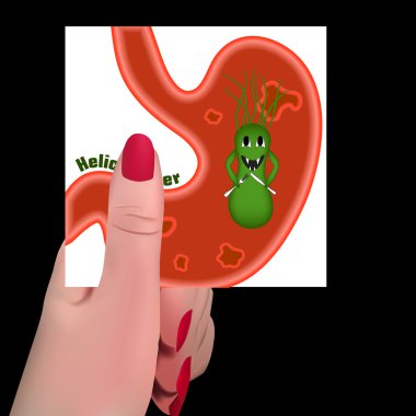 Helicobacter pylori. Ulcers. clipart