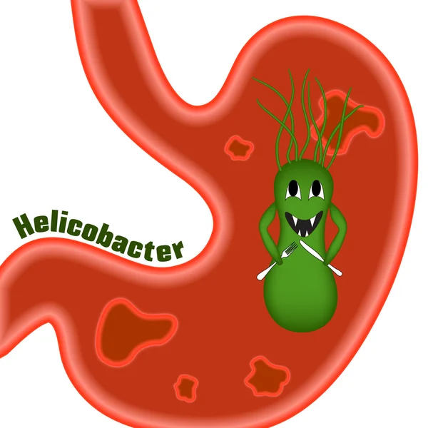 Helicobacter pylori. Magsår. — Stock vektor