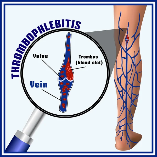 Tromboflebit, blodproppar i venerna. Embolism. Trombos — Stock vektor