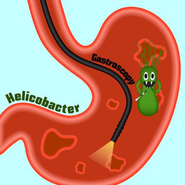 Gastroscopy, research of a stomach gastroscope. Helicobacter pylori. Ulcers.  clipart