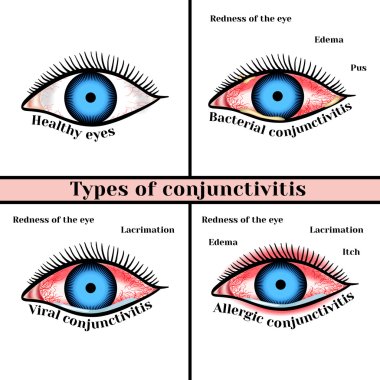 Conjunctivitis types. Inflammatory diseases of eyes. clipart