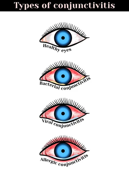 Conjunctivitis types. Inflammatory diseases of eyes. — Stock Vector