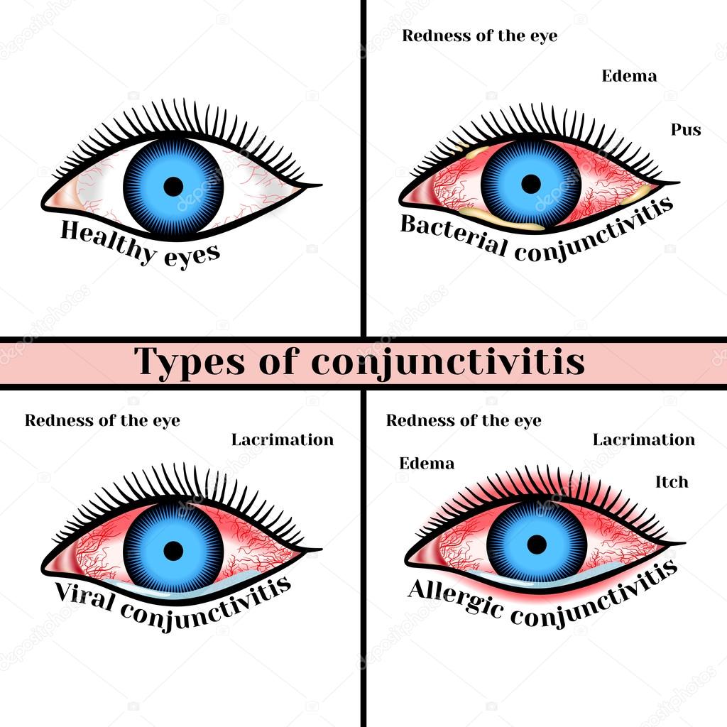 Eye 2024 inflammation types