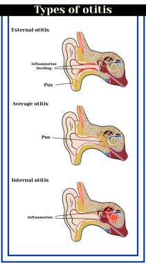 Otitis türleri: otitis dış, ortalama ve iç. Kulak iltihabi hastalıkları.      