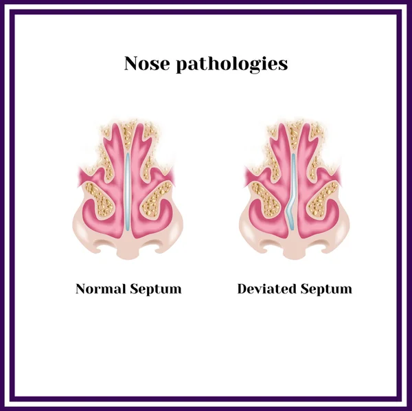 Septum dévié. Pathologie nasale . — Image vectorielle