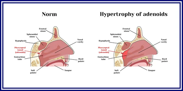 Locatie gemeente adenoïden. De structuur van de Nasofarynx. Norm en hypertrofie van adenoid. — Stockvector