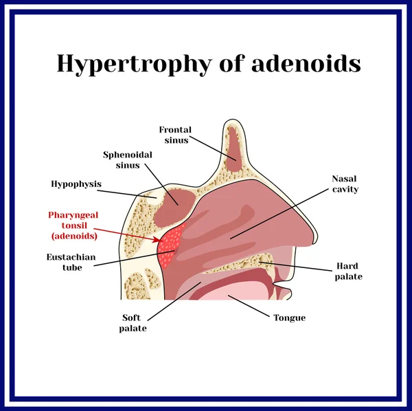 Ubicación de las adenoides.Estructura de la nasofaringe. Hipertrofia de la adenoide . — Vector de stock