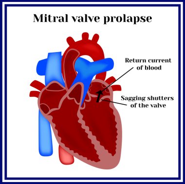 Kalp yapısı. Mitral kapak prolapsusu. Kardiyak patoloji.