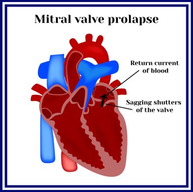 Heart structure. Mitral valve prolapse. Cardiac pathology. clipart