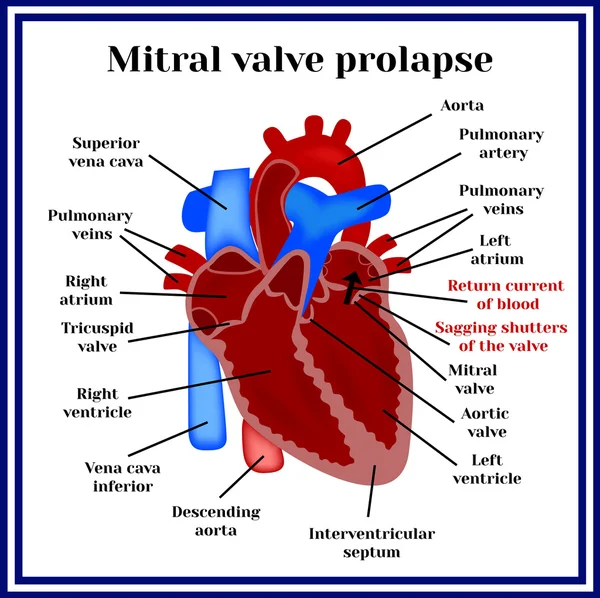 Structuur van het hart. Prolaps van de mitralisklep. Cardiale pathologie. — Stockvector