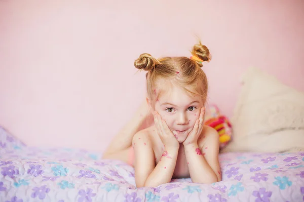 Baby on bed with chicken pox rash — Stock Photo, Image