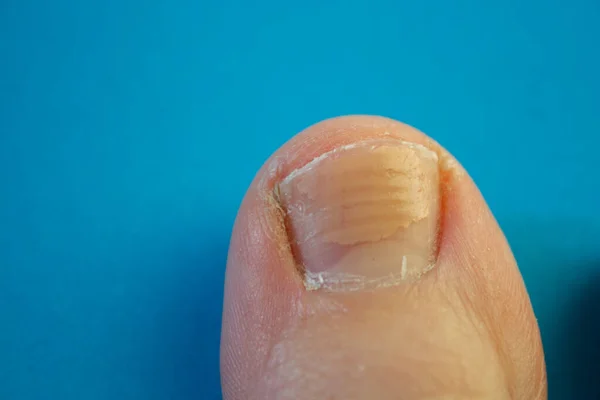 Big toe nail. Ugly nails