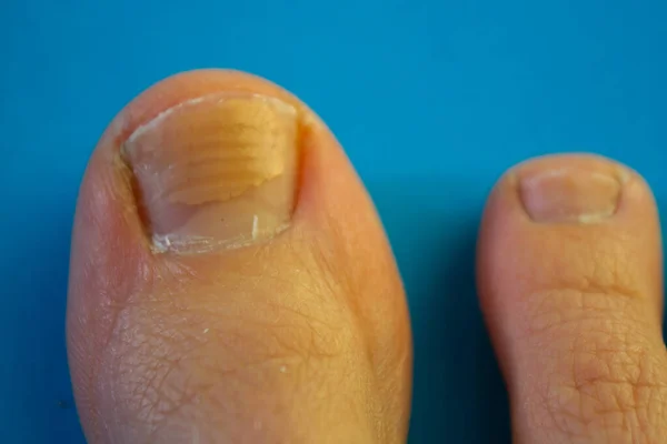 Big toe nail. Ugly nails
