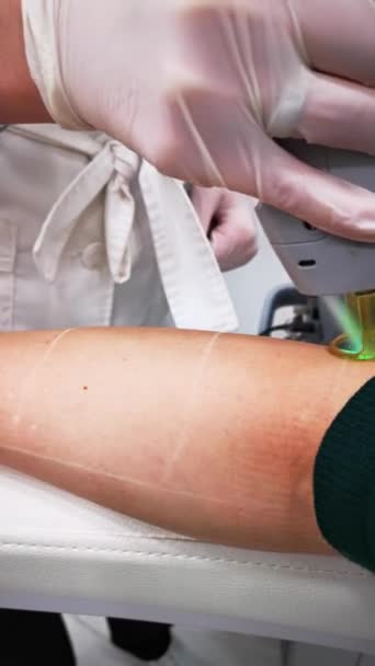 Médico elimina el cabello en la mano femenina con láser — Vídeo de stock