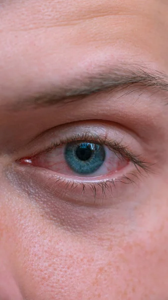 Fechar Olhos Vermelhos Infectados Irritados Conjuntivite Inflamação Dos Olhos Mens — Fotografia de Stock